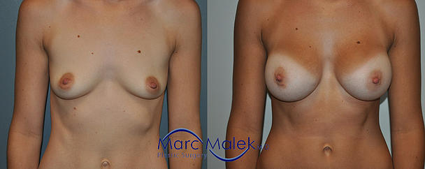 Breast Augmentation With Saline Before and After breastau