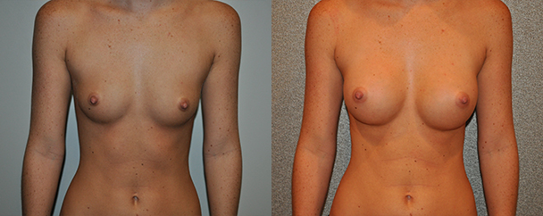 Breast Augmentation With Saline Before and After breastau
