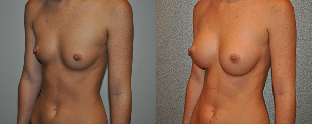 Breast Augmentation With Saline Before and After breastau