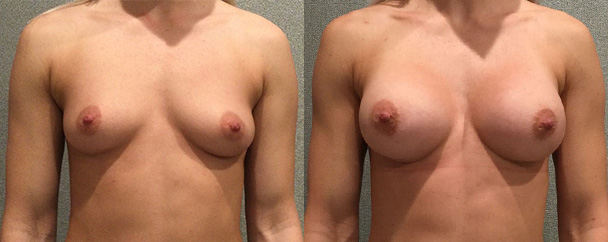 Breast Augmentation With Silicone Before and After breastau
