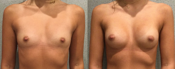 Breast Augmentation With Silicone Before and After breastau