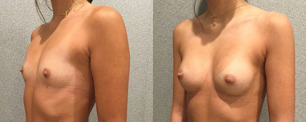 Breast Augmentation With Silicone Before and After breastau