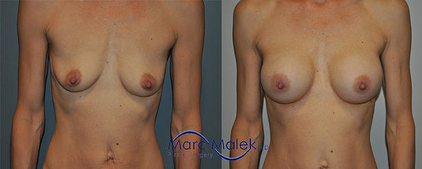 Breast Augmentation With Silicone Before and After breastau