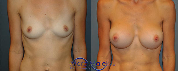 Breast Augmentation With Silicone Before and After breastau