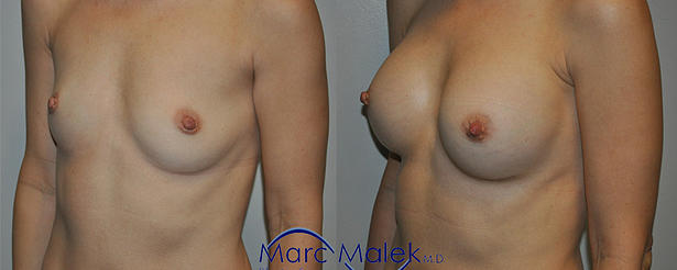 Breast Augmentation With Silicone Before and After breastau