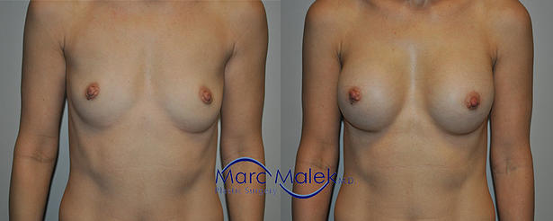 Breast Augmentation With Silicone Before and After breastau