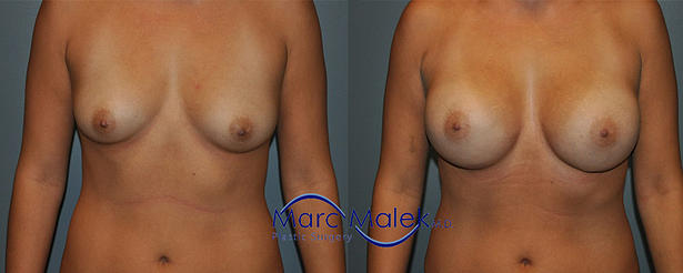 Breast Augmentation With Silicone Before and After breastau