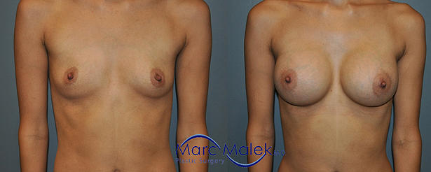 Breast Augmentation With Silicone Before and After breastau