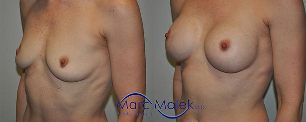 Breast Augmentation With Silicone Before and After breastau