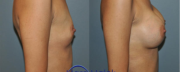 Breast Augmentation With Silicone Before and After breastau