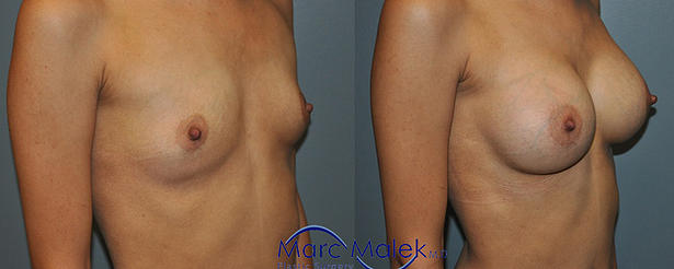 Breast Augmentation With Silicone Before and After breastau