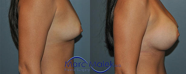 Breast Augmentation With Silicone Before and After breastau