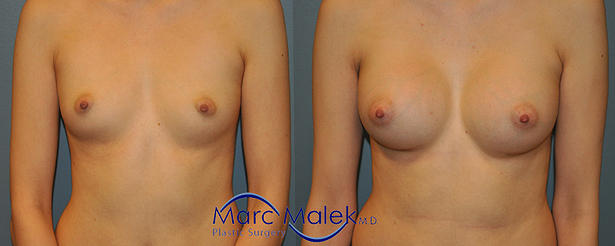 Breast Augmentation With Silicone Before and After breastau