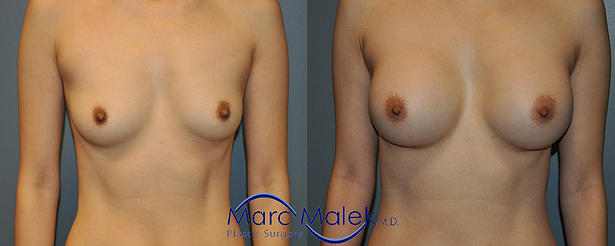 Breast Augmentation With Silicone Before and After breastau