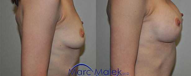 Breast Augmentation With Silicone Before and After breastau