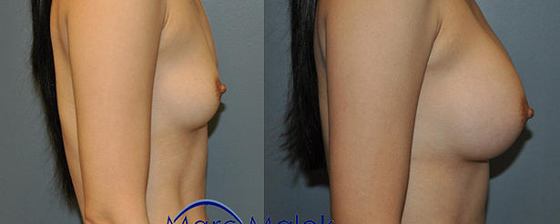 Breast Augmentation With Silicone Before and After breastau