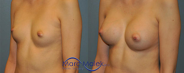 Breast Augmentation With Silicone Before and After breastau