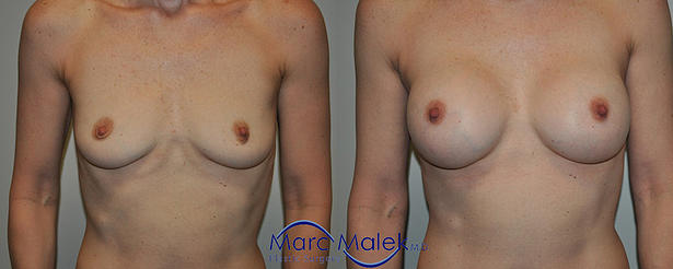 Breast Augmentation With Silicone Before and After breastau