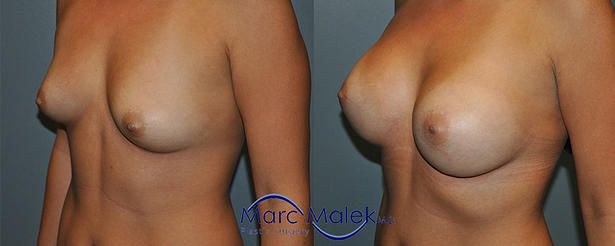 Breast Augmentation With Silicone Before and After breastau