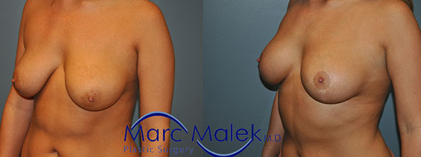Breast Lift Before and After breastli