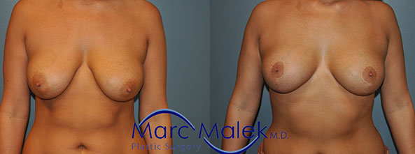 Breast Lift Scottsdale Before & After
