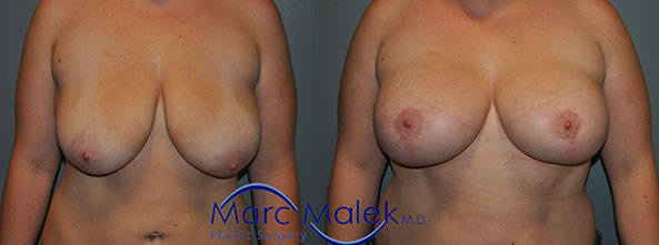 Breast Lift Before and After breastli