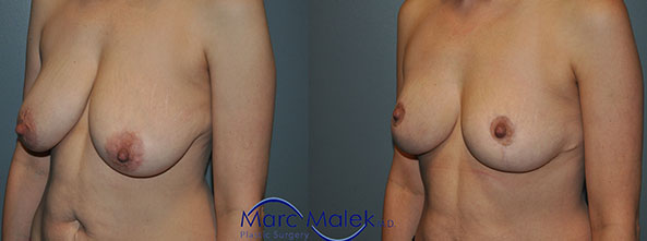 Breast Lift Before and After breastli