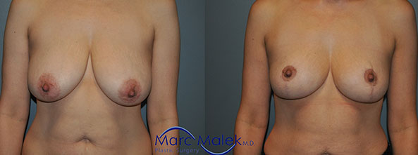 Breast Lift Scottsdale Before & After