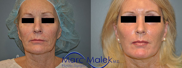 Co2 Laser Resurfacing Before and After co2laser