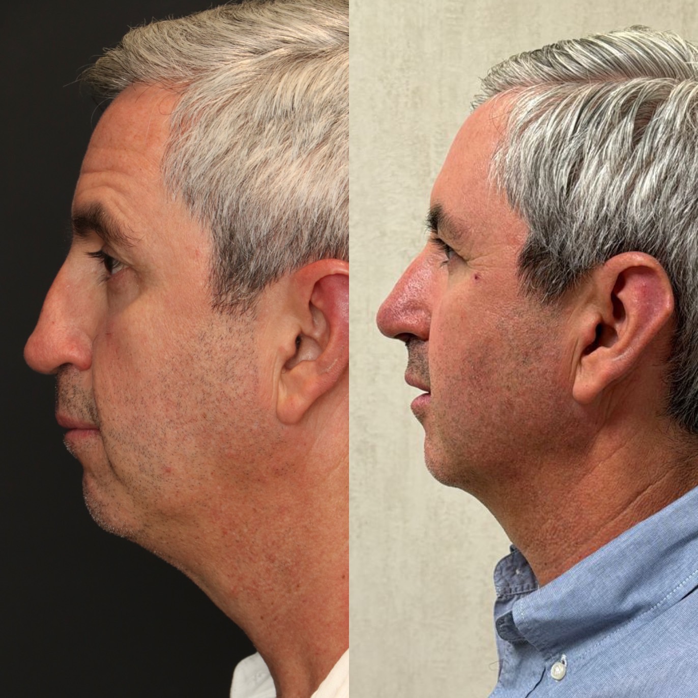Dr Devictor Revision Rhinoplasty Before and After drdevict