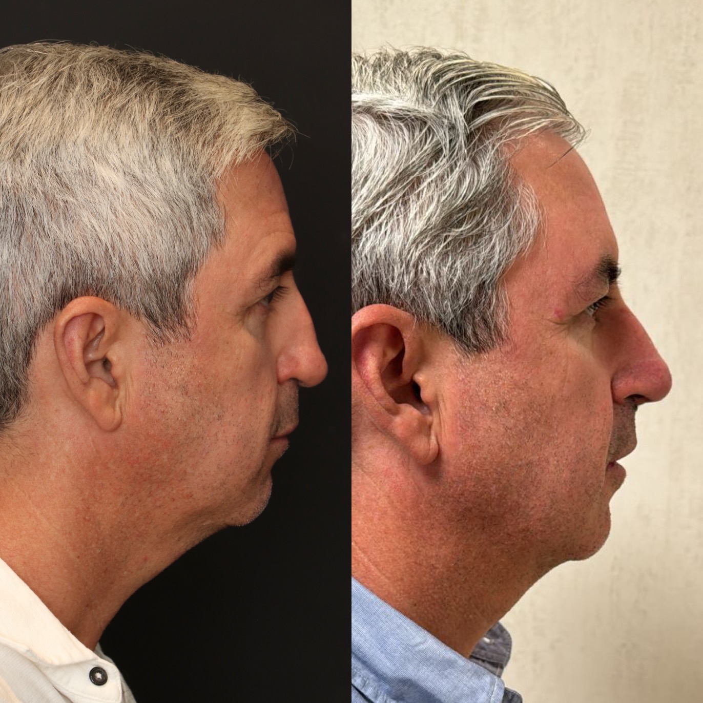 Dr Devictor Revision Rhinoplasty Before and After drdevict