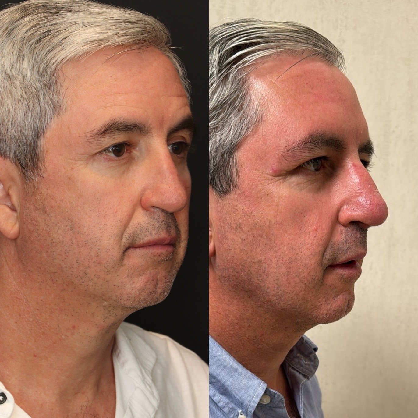 Dr Devictor Revision Rhinoplasty Before and After drdevict