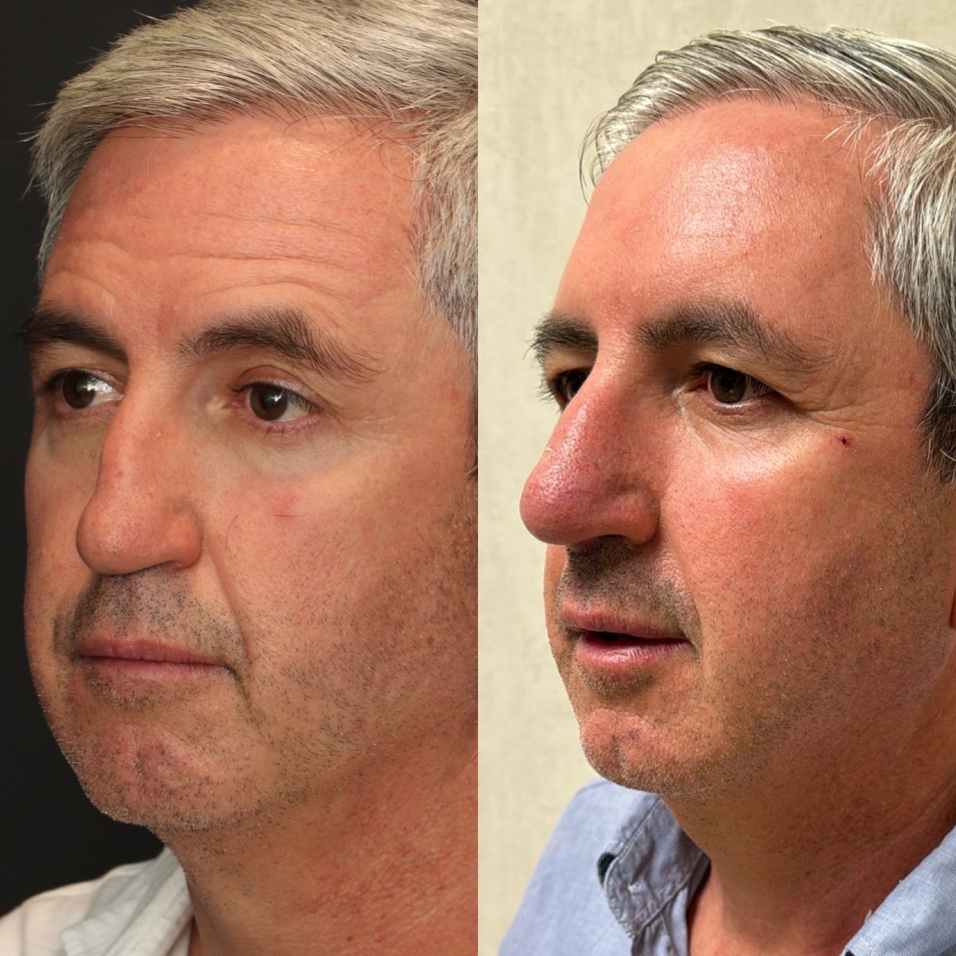 Dr Devictor Revision Rhinoplasty Before and After drdevict