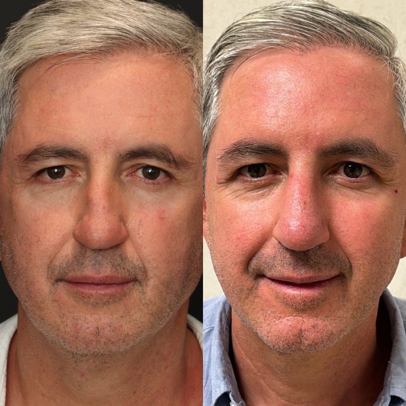Dr Devictor Revision Rhinoplasty Before and After drdevict