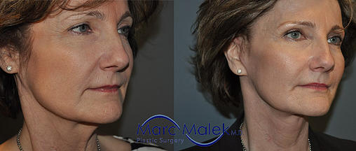Facelift Phoenix Before & After