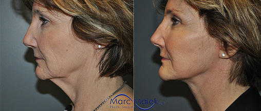 Facelift Before and After facelift
