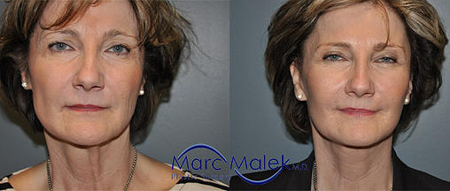 Facelift Before and After facelift
