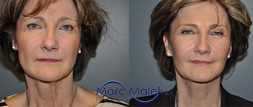 Facelift Phoenix Before & After