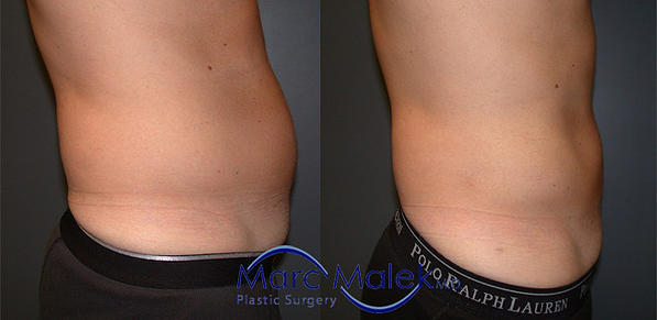 Liposuction For Men Before and After liposuct