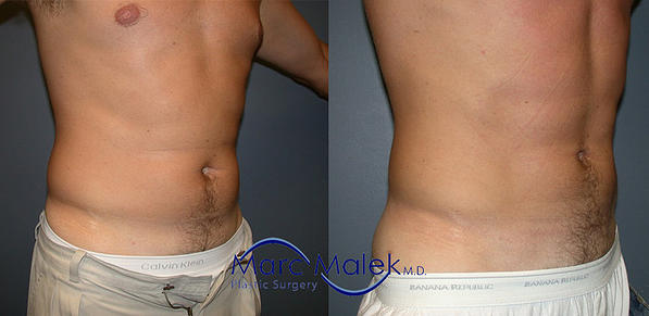 Male Flanks Liposuction - KleinLipo - Liposuction Surgery of Orange County