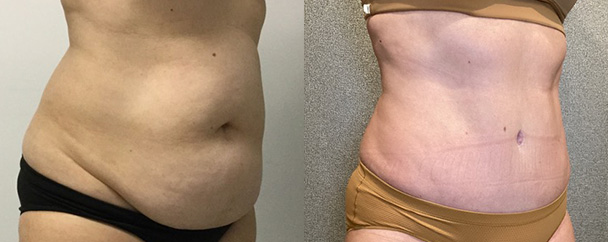Liposuction Phoenix Before & After