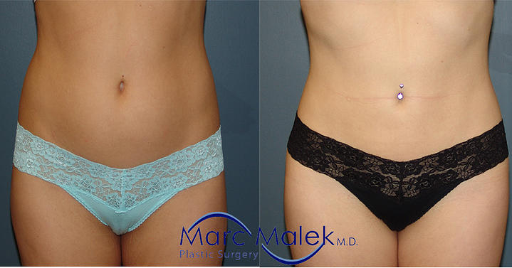 Liposuction Scottsdale Before & After