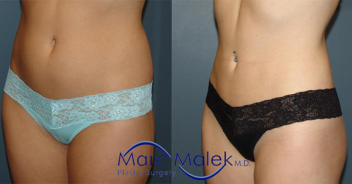 Liposuction Phoenix Before & After