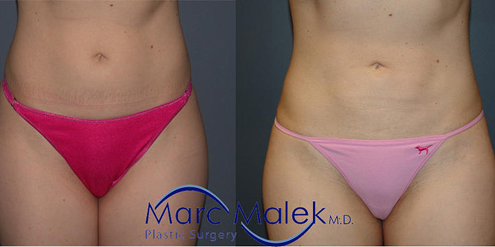 Liposuction Before and After liposuct