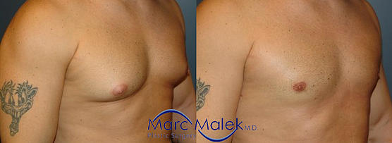 Male Breast Reduction Surgery Before and After malebrea