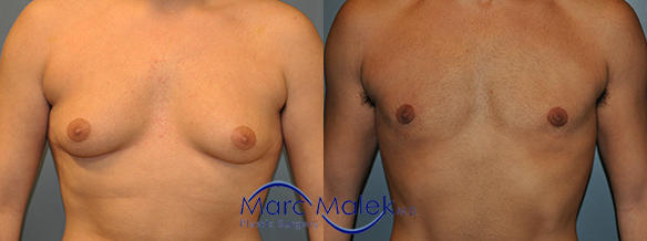 Male Breast Reduction Surgery Before and After malebrea