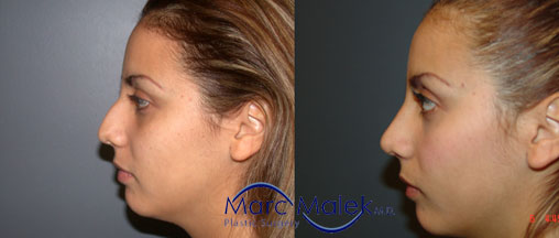 Rhinoplasty Phoenix Before & After