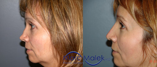 Rhinoplasty Scottsdale Before & After