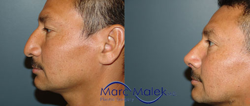 Rhinoplasty Phoenix Before & After