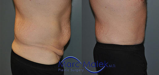 Tummy Tuck For Men Before and After tummytuc